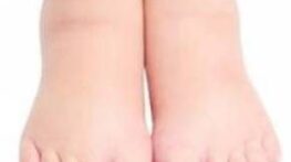 درمان ورم طبیعی پا با نسخه های خانگی و فوری