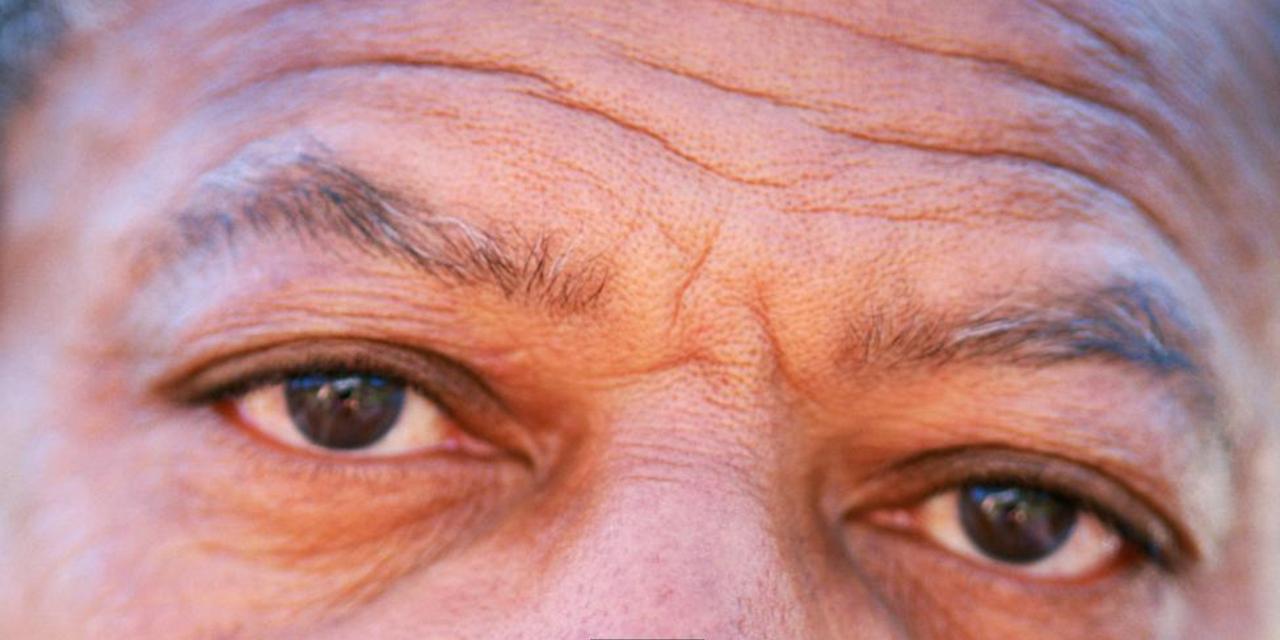 دلیل ایجاد چین و چروک پیشانی چیست و چگونه رفع می شود؟