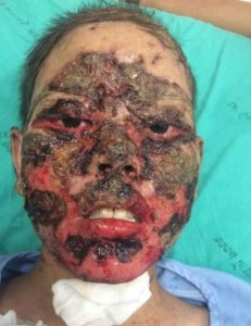 تجویز داروی اشتباه باعث شد صورت دختر از بین برود! +عکس تجویز داروی اشتباه باعث شد صورت دختر از بین برود! +عکس