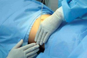 عوارض و خطرات جبران ناپذیر جراحی لاغری عوارض و خطرات جبران ناپذیر جراحی لاغری