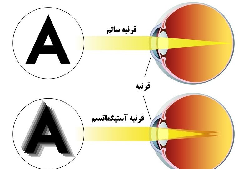 آستیگماتیسم