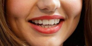 چال گونه | چگونه بدون عمل جراحی چال گونه زیبا داشته باشیم؟