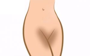 روش های رفع تیرگی ناحیه تناسلی و  سفید کردن پوست