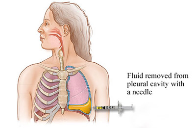 علائم و درمان پنوموتوراکس و اطلاعاتی در مورد این بیماری