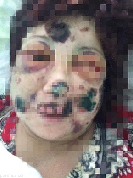 پرستار زن توسط دوست پسرش زنده زنده خورده شد!