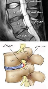 دیسک کمر خفیف و شدید چه تفاوتی دارند و آیا نیاز به جراحی دارند؟ دیسک کمر خفیف و شدید چه تفاوتی دارند و آیا نیاز به جراحی دارند؟