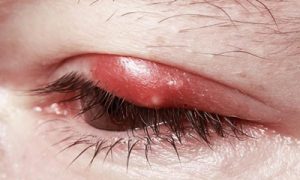 دلیل ایجاد گل مژه و شالازیون و درمان این مشکل چشمی