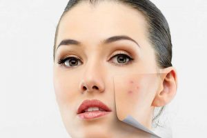 چگونه جوش هورمونی صورت را درمان کنیم؟