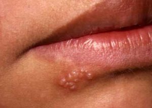 دلیل تبخال زدن چیست؟ +راه درمان