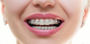 معرفی انواع روش ارتودنسی و بهترین روش ارتودنسی برای دندان های شما معرفی انواع روش ارتودنسی و بهترین روش ارتودنسی برای دندان های شما