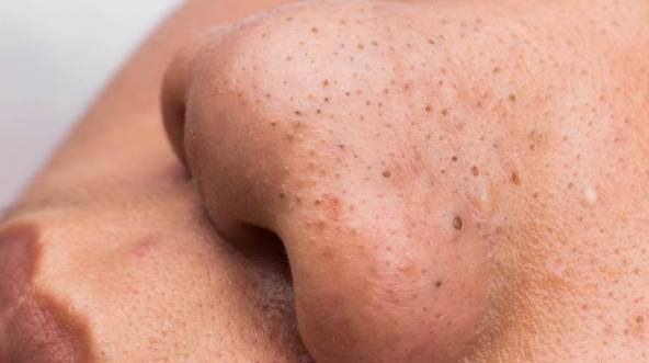 روش سریع درمان “جوش های سرسیاه” روی بینی با ماسک خانگی