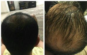 رویش مجدد موهای سر با رعایت کردن این نکات رویش مجدد موهای سر با رعایت کردن این نکات