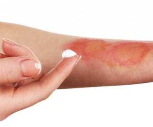 روش درمان سوختگی پوست دست با روغن داغ هنگام آشپزی روش درمان سوختگی پوست دست با روغن داغ هنگام آشپزی