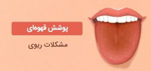 تغییر رنگ زبان و رنگ زبان صورتی، قرمز، خاکستری، زرد، بنفش و ... نشانه چه بیماری است؟ تغییر رنگ زبان و رنگ زبان صورتی، قرمز، خاکستری، زرد، بنفش و … نشانه چه بیماری است؟