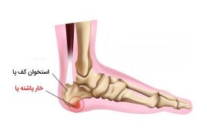 دلیل "خار پاشنه پا" چیست و خار پاشنه چطور درمان می شود؟ دلیل “خار پاشنه پا” چیست و خار پاشنه چطور درمان می شود؟