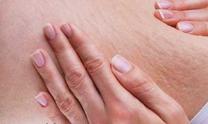 چطور ترک های پوستی را محو کنید و پوستی صاف داشته باشیم؟