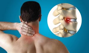 آرتروز گردن | دلیل ایجاد آرتروز گردن علائم آن و روش های پیشگیری