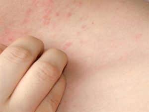 پماد تاکرولیموس Tacrolimus | موارد مصرف و عوارض پماد تاکرولیموس