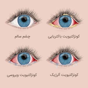 دلایل ایجاد بیماری چشم صورتی و علائم و راه درمان این بیماری دلایل ایجاد بیماری چشم صورتی و علائم و راه درمان این بیماری