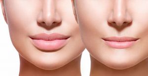 فیلر لب + روش استفاده از فیلر لب برای بزرگ کردن لب و اطلاعات در مورد این روش زیبایی