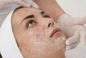 پماد ترتینوئین برای آکنه + اطلاعات دارویی و نحوه مصرف و عوارض