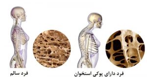 اطلاعاتی در مورد تراکم استخوان + مواد غذایی برای تراکم استخوانی بیشتر