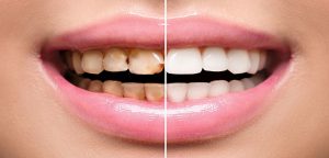 جرم گیری دندان در خانه + روش های مختلف از بین بردن جرم ها جرم گیری دندان در خانه + روش های مختلف از بین بردن جرم ها