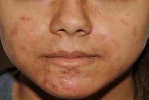 قرص آکوتان برای مشکلات پوستی + نحوه مصرف و عوارض این دارو