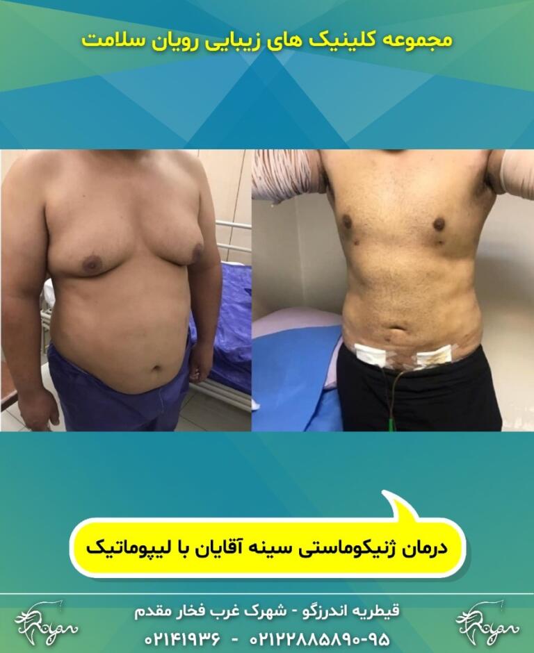 لیپوماتیک بهتر است یا لیپوساکشن؟