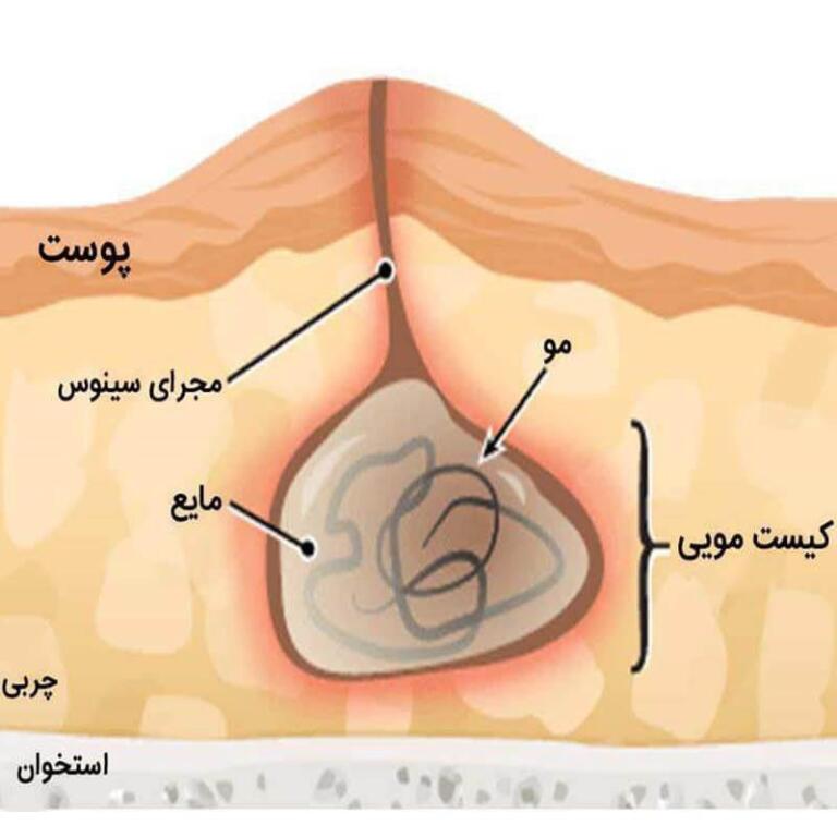 بیماری کیست مویی و علل ایجاد آن چیست؟