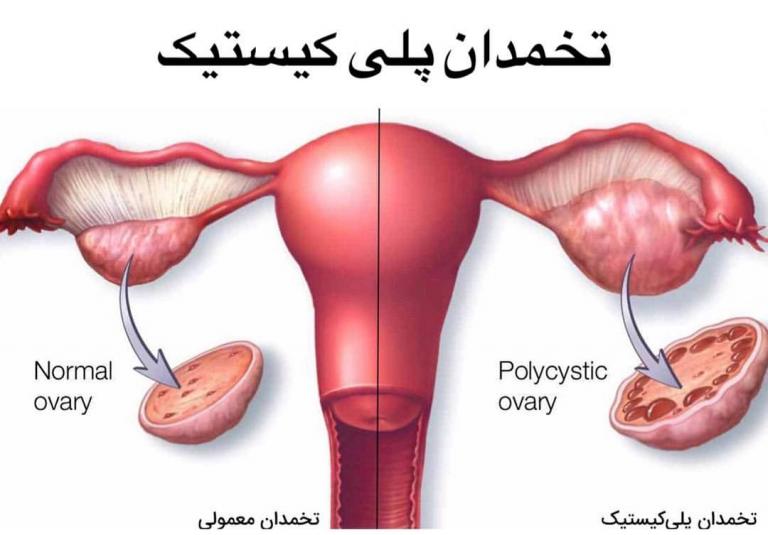 روش درمان تنبلی تخمدان با ورزش روش درمان تنبلی تخمدان با ورزش