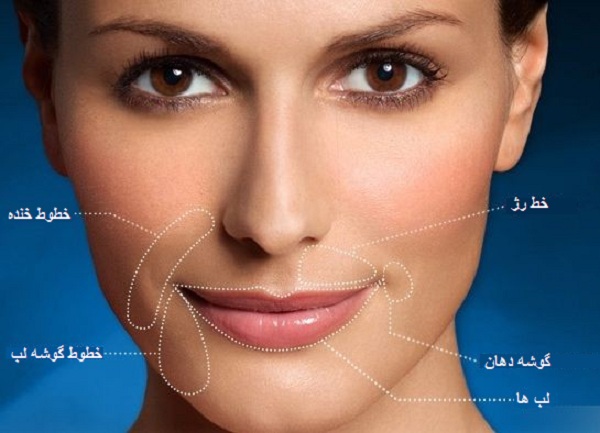 رفع خط خنده