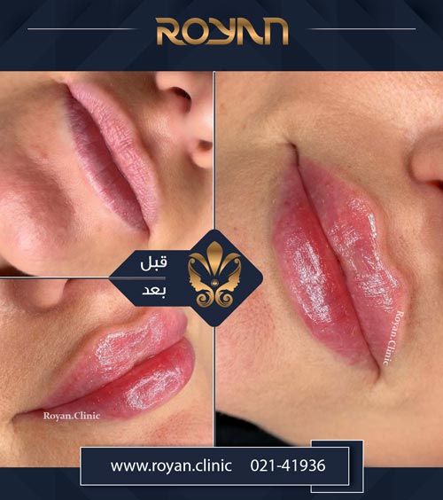 تزریق ژل لب چیست
