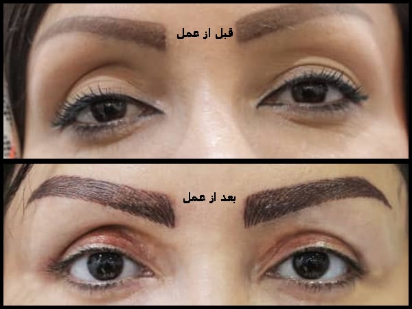 افتادگی پلک چیست؟ علائم و تمام روش های درمان آن