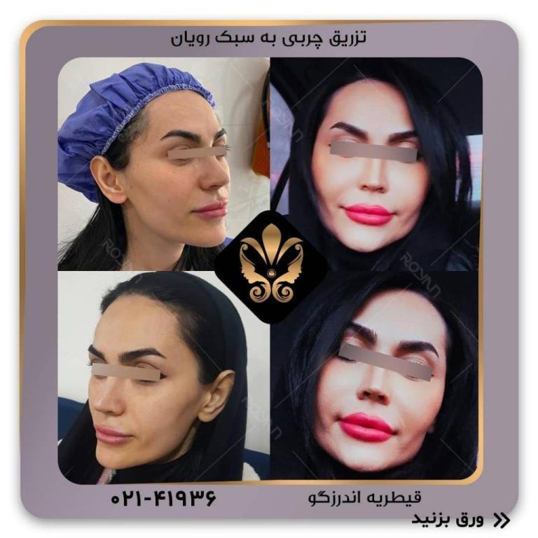 هزینه تزریق چربی چقدر است و به چه عواملی بستگی دارد؟ هزینه تزریق چربی چقدر است و به چه عواملی بستگی دارد؟