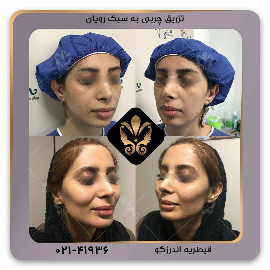 هزینه تزریق چربی چقدر است 