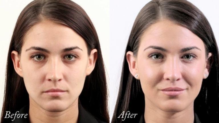 لیفتینگ صورت؛ با جراحی یا بدون جراحی؟