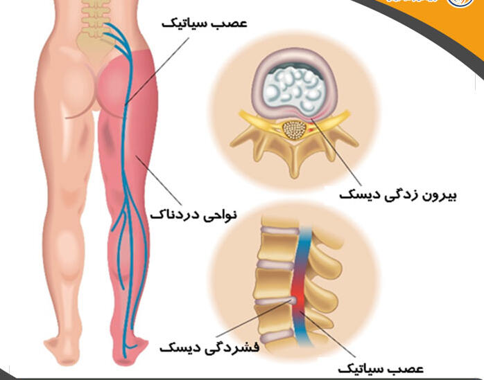 روش های درمان سیاتیک بدون جراحی + علائم و دلیل ایجاد سیاتیک