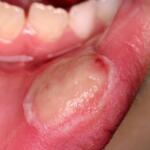آفت دهان چیست، چطور ایجاد می شود و چه علائمی دارد؟ آفت دهان چیست، چطور ایجاد می شود و چه علائمی دارد؟