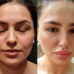 جراحی بوکال فت چیست و چه کسانی می توانند انجام دهند؟ جراحی بوکال فت چیست و چه کسانی می توانند انجام دهند؟