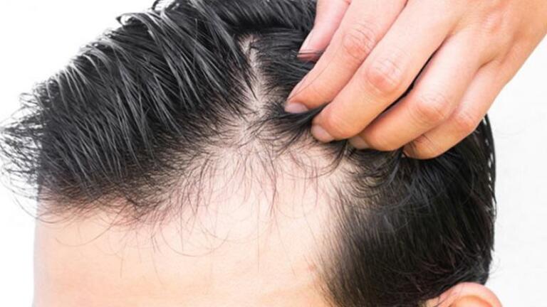 بهترین تجربه درمان ریزش مو مربوط به کدام روش است؟