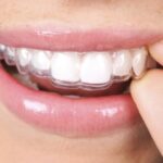اطلاعات درباره ارتودنسی نامرئی؛ نحوه انجام و مزایای انجام این روش