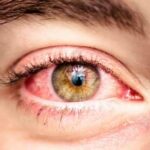 علت خستگی چشم یا آستنوپیا چیست و چگونه درمان می شود؟ علت خستگی چشم یا آستنوپیا چیست و چگونه درمان می شود؟