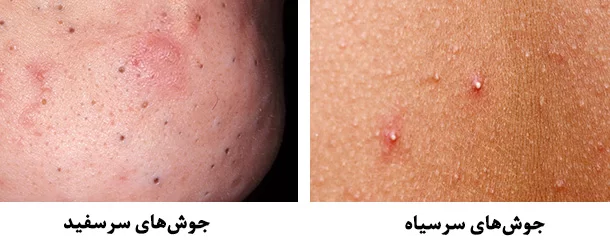 تخلیه جوش زیر پوستی | روش های درمان جوش های زیر پوستی