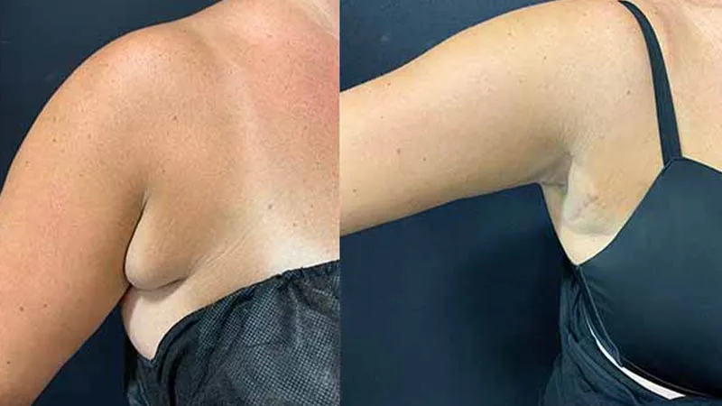 حقایق جالب درباره چربی زیر بغل؛ دلایل ایجاد و روش های از بین بردن