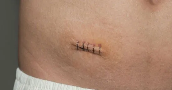 آپاندیس کجاست؟ عوامل ایجاد آپاندیسیت و روش های درمان آن