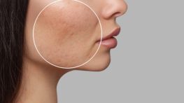 از بین بردن منافذ باز پوست