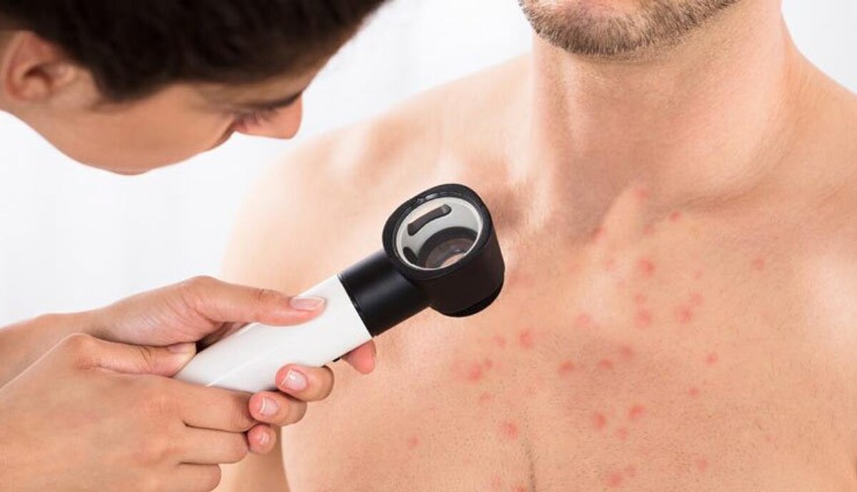 جوش سینه چرا به وجود می آید و چگونه درمان می شود؟ 2081780 168