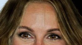 بیرون زدگی رگ پیشانی