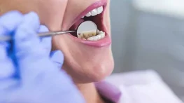 از بین بردن زردی دندان